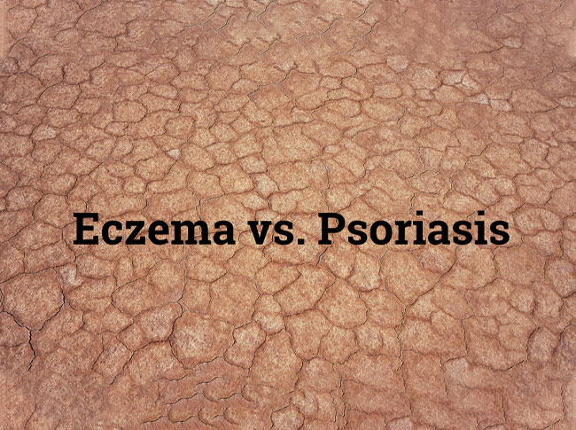 Eczema vs Psoriasis: What You Need to Know