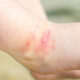 Child/ Baby Eczema: Is Moisturising Doing More Harm than Good?